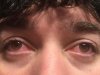 Eye irritation.jpg